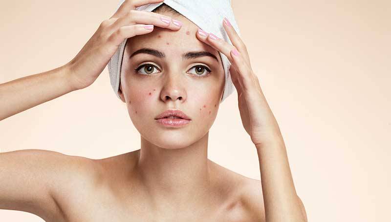 Wat is Acne?